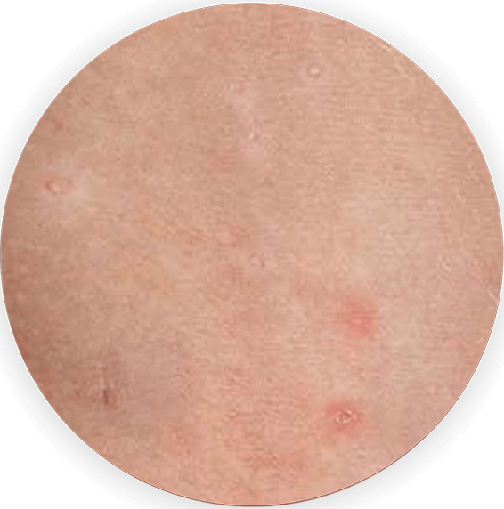 Side-by-side circular image showing a close-up comparison of molluscum lesions before and after ZELSUVMI treatment, with visible improvement