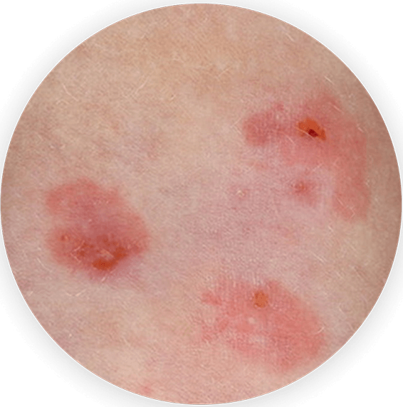 Side-by-side circular image showing a close-up comparison of molluscum lesions before and after ZELSUVMI treatment, with visible improvement