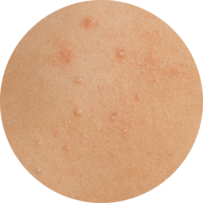 Close-up image showing multiple raised molluscum lesions on skin